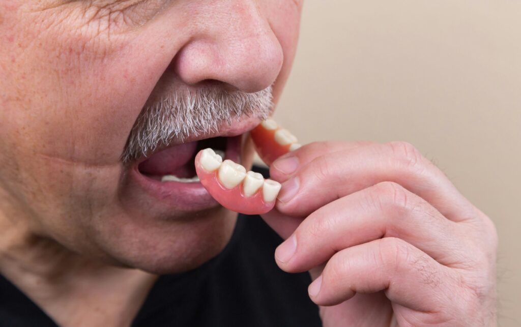 denture sores showing red irritated gum tissue with pressure sore from ill-fitting lower denture on alveolar ridge