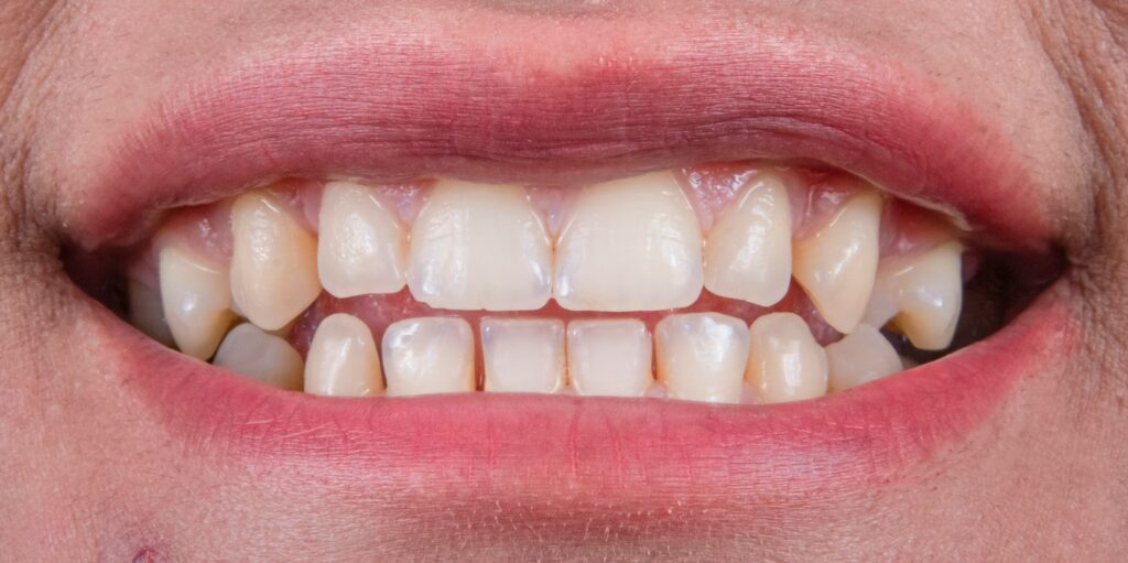 Are ZYNs bad for your gums showing a nicotine pouch placed against the gum line with visible tissue irritation representing the oral health effects of ZYN nicotine pouches on gum tissue