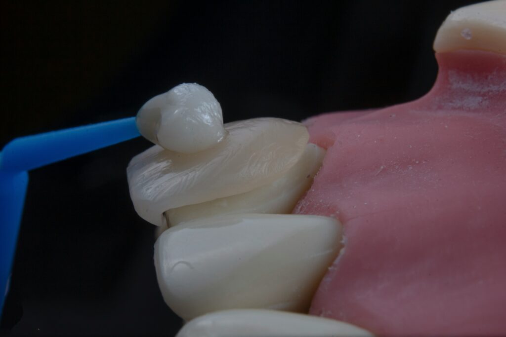 gum flap between teeth showing inflamed loose gum tissue lifting away from tooth surface