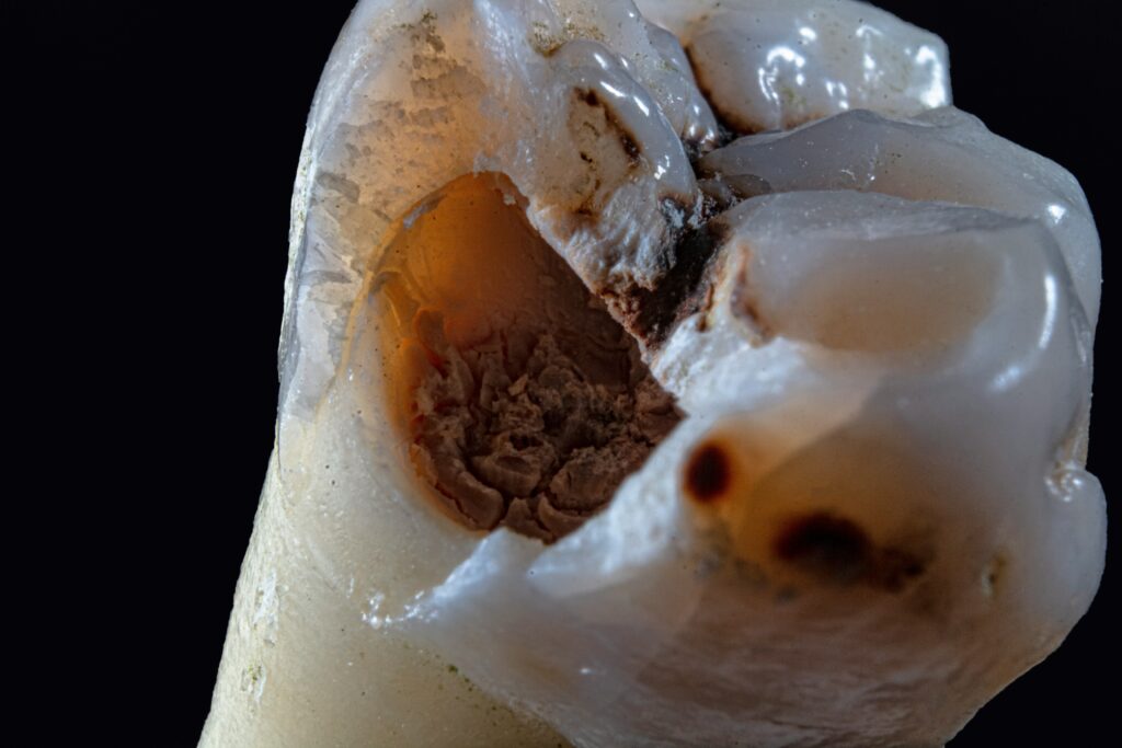 normal vs dry socket comparison showing what a healthy blood clot looks like in a tooth extraction socket versus an exposed bone dry socket to help identify post-extraction complications