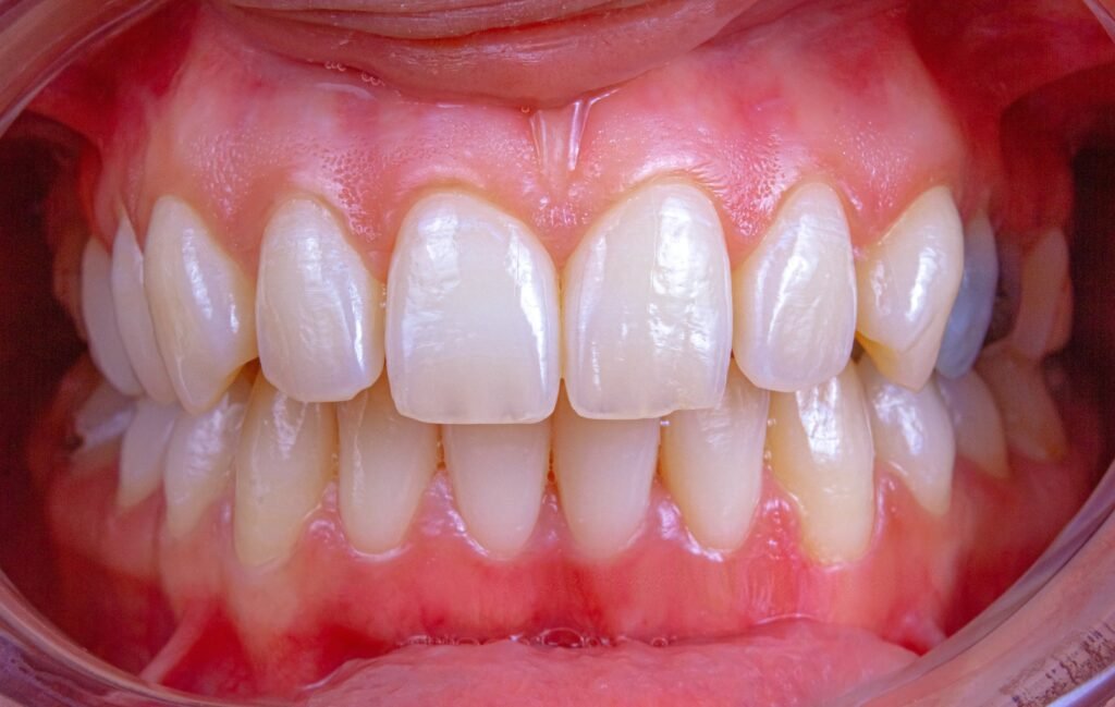 Dental guide showing teeth alignment representing how to fix overbite naturally how to fix gummy smile resting teeth position loose tooth cracked tooth naturally loose dental filling guide